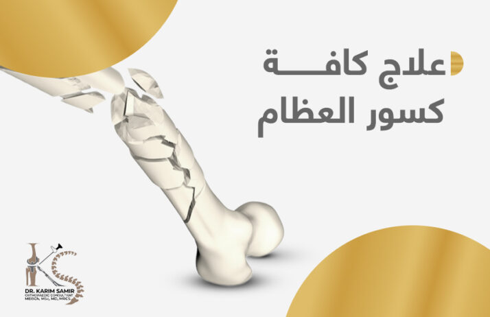 علاج كسور العظام