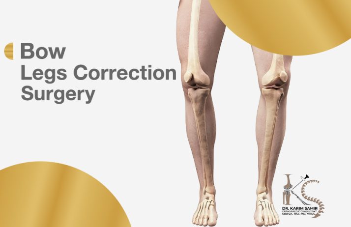 Bow Legs Correction Surgery