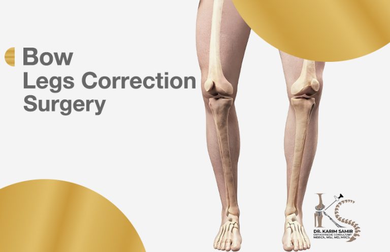Bow Legs Correction Surgery