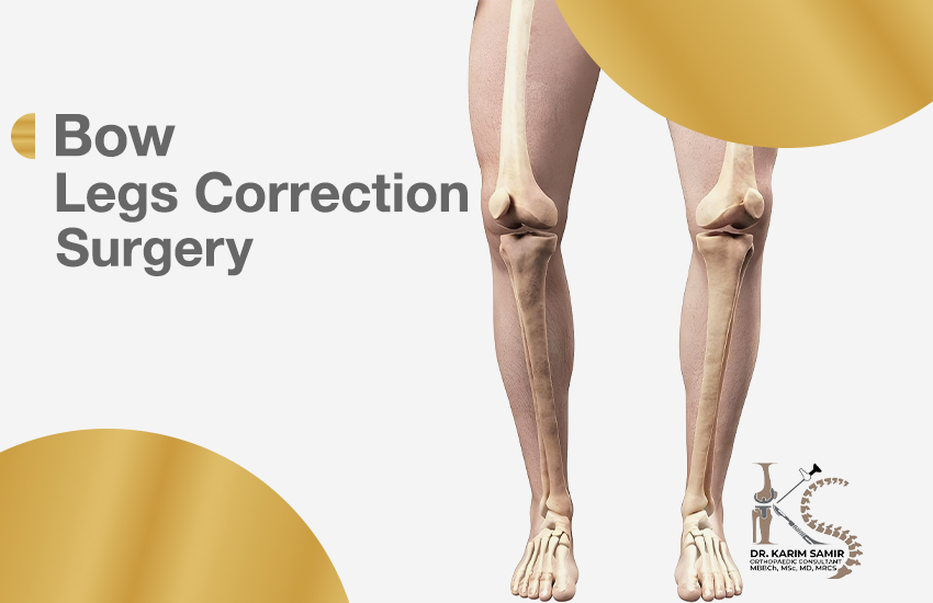 Bow Legs Correction Surgery