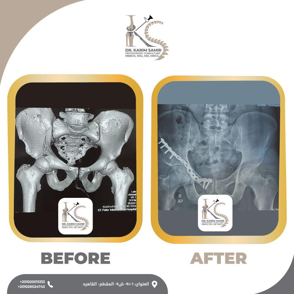 صورة أشعة سينية لمفصل فخذ صناعي ناجح بعد الجراحة