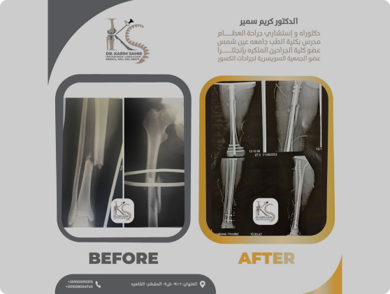 خشونة الركبة ومشاكل الغضروف - صورة توضيحية