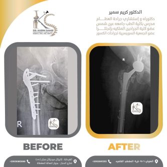 تغيير مفصل الفخذ بالكامل بمفصل ذو جذع طويل 