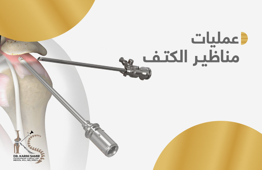 عملية منظار الكتف