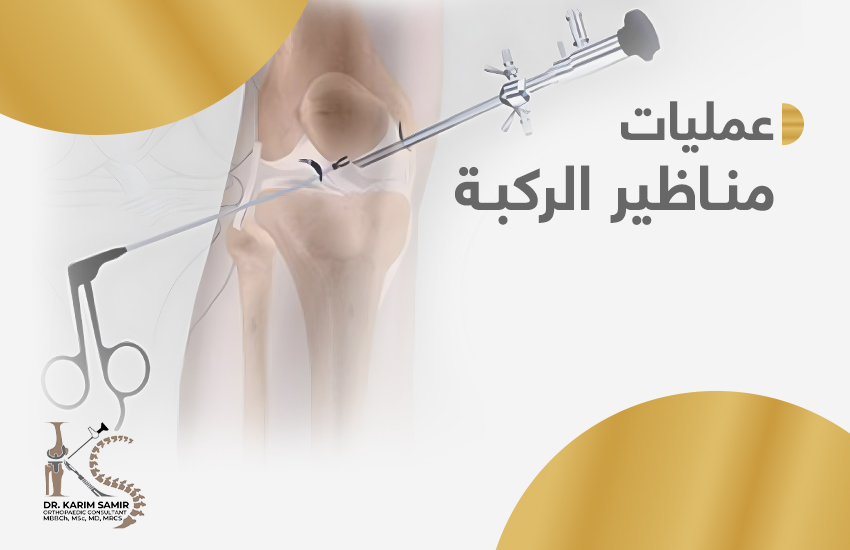 عملية منظار الركبة