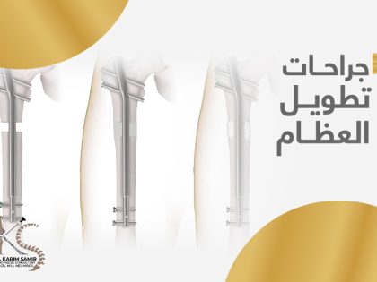 جراحات-تطويل-العظام