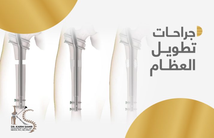 جراحات تطويل العظام