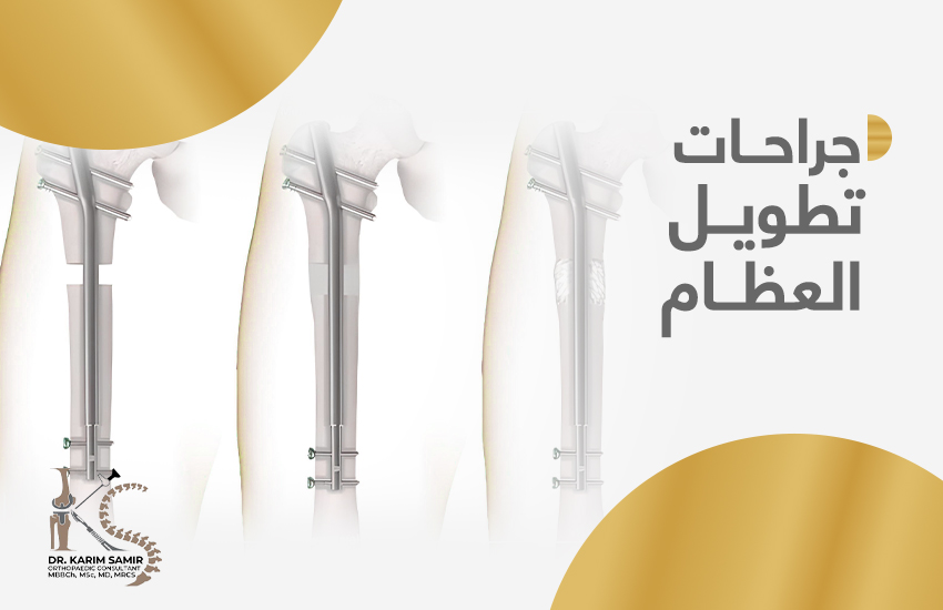 جراحات تطويل العظام