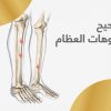 تصحيح تشوهات العظام
