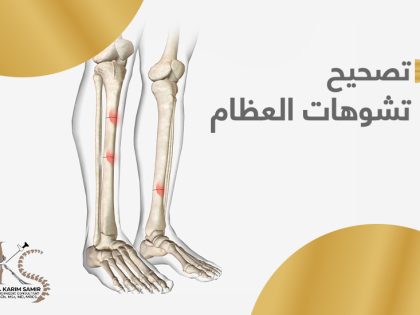 تصحيح تشوهات العظام