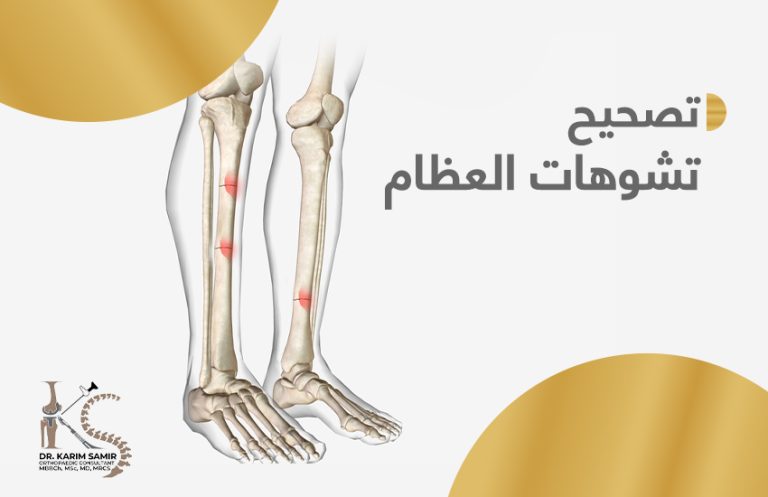تصحيح تشوهات العظام