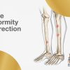 deformity correction