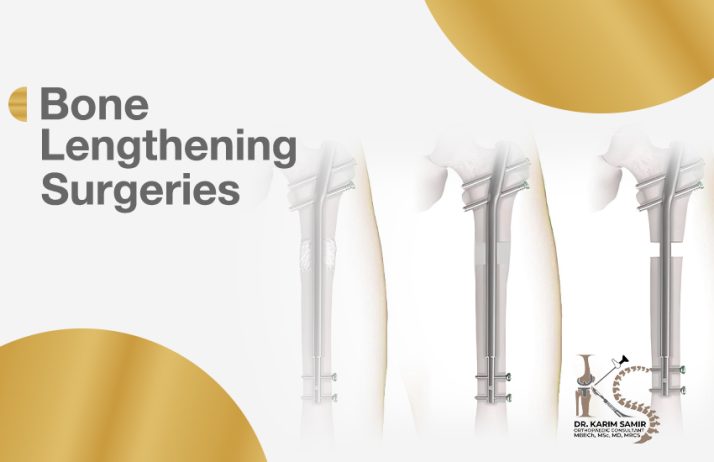 Limb Lengthening Surgery