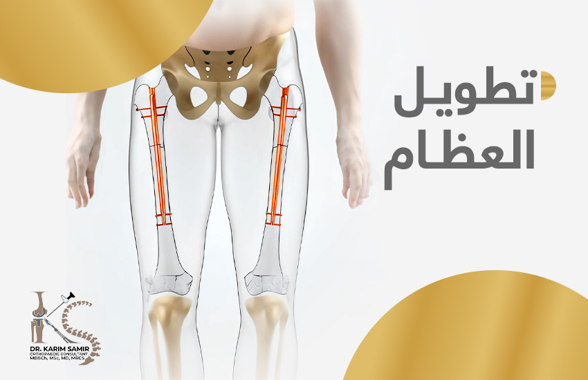 عملية تطويل القامة