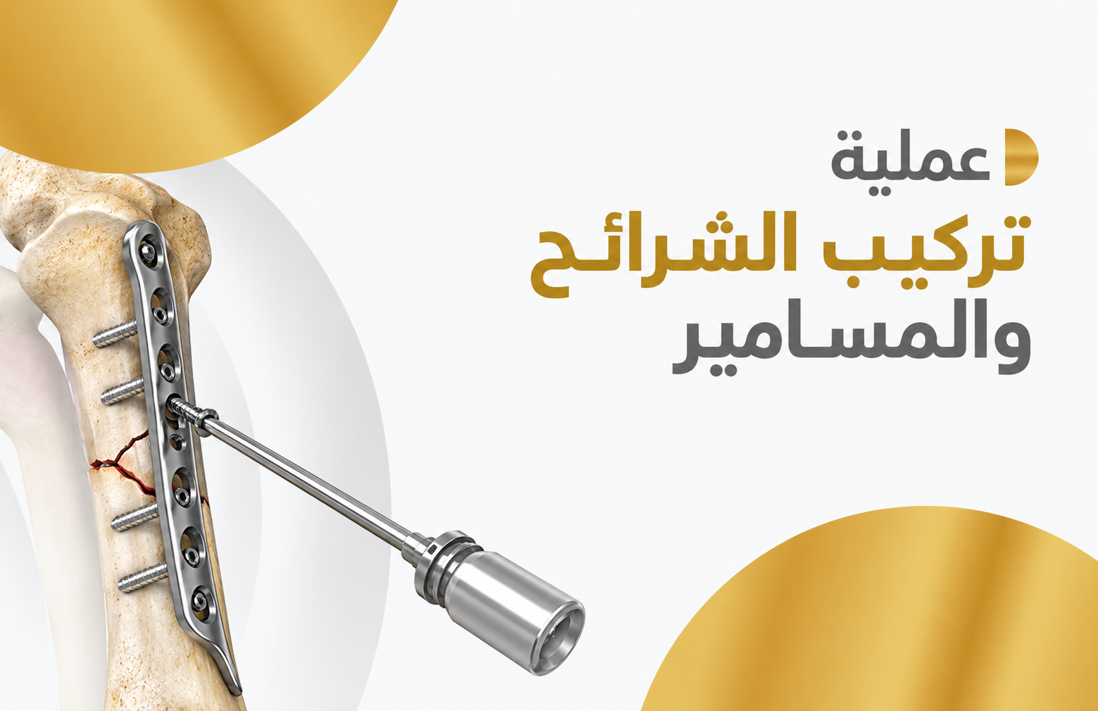 عملية تركيب الشرائح والمسامير